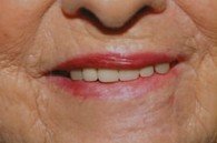 After treatment