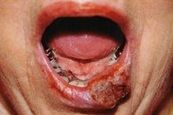 Before treatment